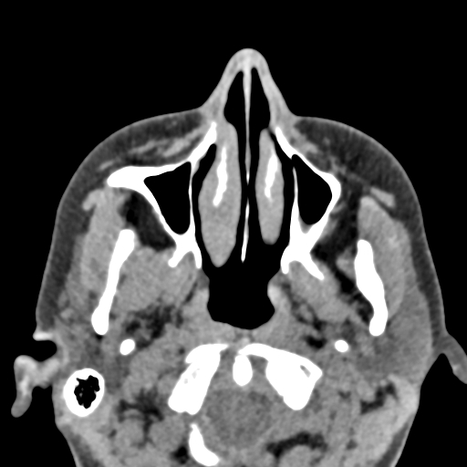 Angular dermoid cyst (Radiopaedia 88967-105790 Axial non-contrast 10).jpg