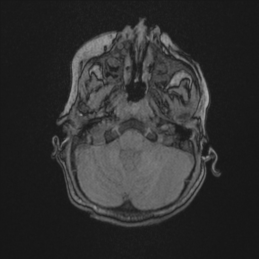 Anoxic brain injury (Radiopaedia 79165-92139 Axial MRA 39).jpg