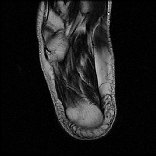 File:Anterior calcaneal process fracture (Radiopaedia 71377-81705 Axial T2 16).jpg
