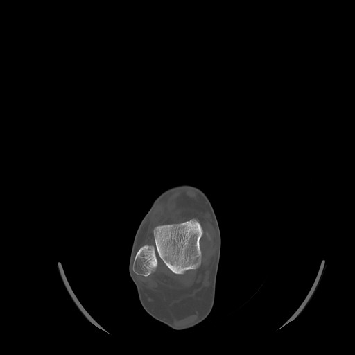 File:Anterior calcaneal process fracture (Radiopaedia 82590-96762 Axial bone window 14).jpg