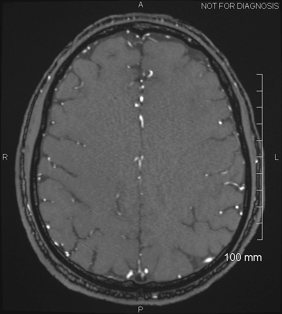 Anterior cerebral artery aneurysm (Radiopaedia 80683-94127 Axial MRA 175).jpg