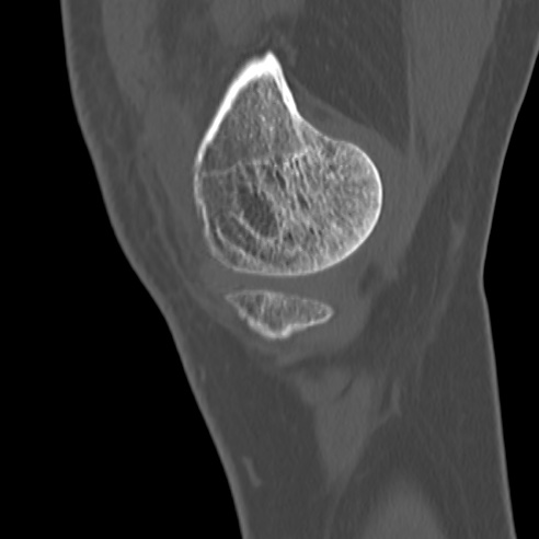 File:Anterior cruciate ligament avulsion fracture (Radiopaedia 58939-66194 Sagittal bone window 35).jpg