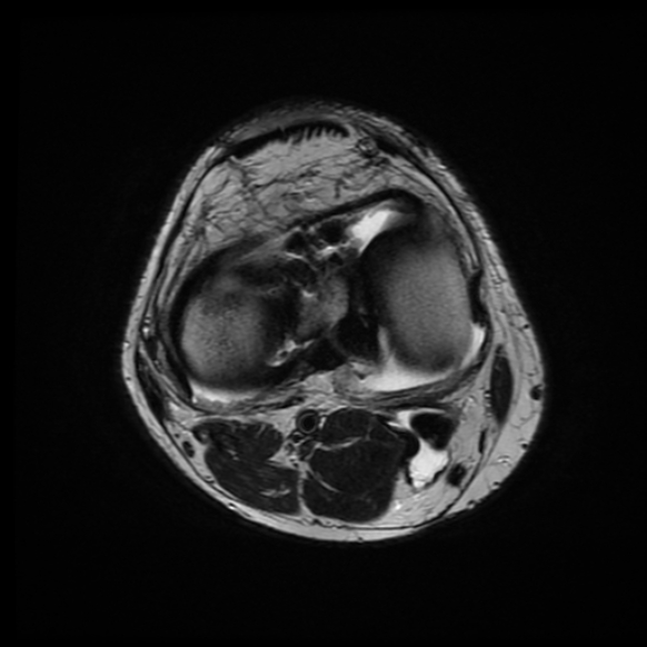 File:Anterior cruciate ligament graft tear and bucket-handle tear of medial meniscus (Radiopaedia 75867-87255 Axial T2 9).jpg
