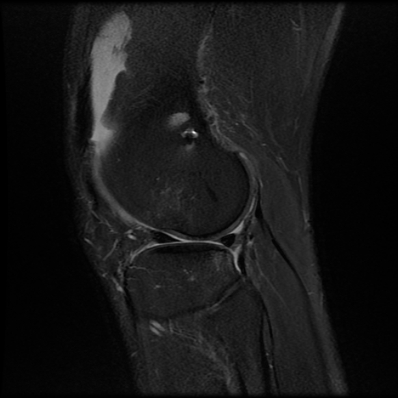 File:Anterior cruciate ligament graft tear and bucket-handle tear of medial meniscus (Radiopaedia 75867-87255 Sagittal PD fat sat 22).jpg