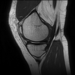 Anterior cruciate ligament rupture and posteromedial corner injury (Radiopaedia 67338-76723 Sagittal PD 48).jpg