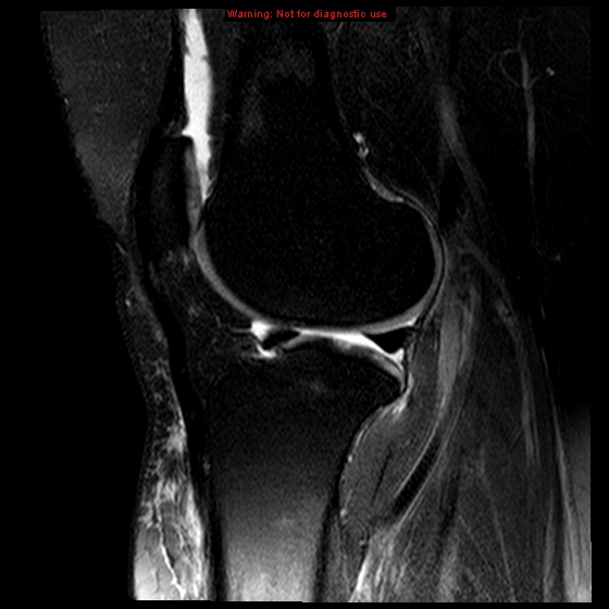 File:Anterior cruciate ligament tear (Radiopaedia 12329-12612 E 8).jpg
