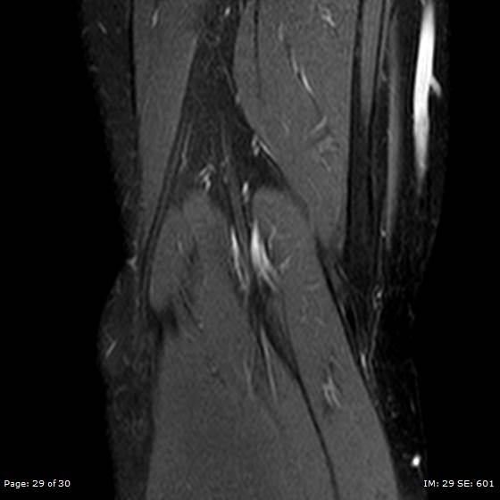 File:Anterior cruciate ligament tear (Radiopaedia 70783-80964 Coronal STIR 29).jpg