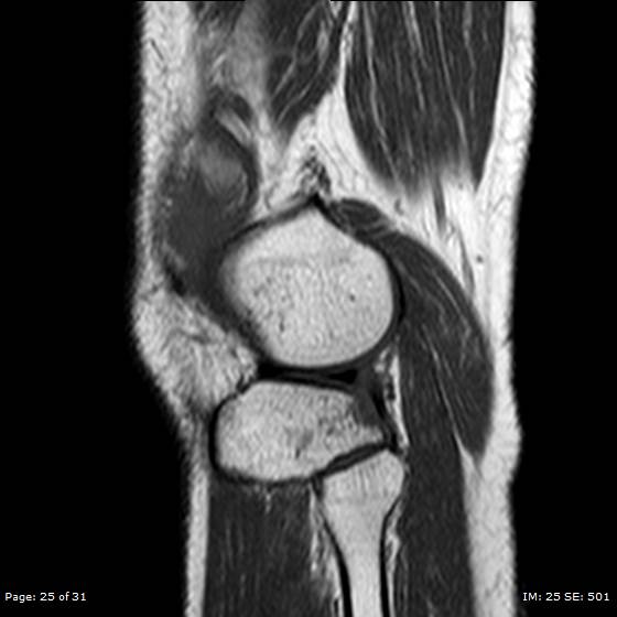 File:Anterior cruciate ligament tear (Radiopaedia 70783-80964 Sagittal T1 25).jpg