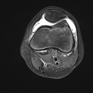 File:Anterior cruciate ligament tear - pediatric (Radiopaedia 62152-70260 Axial PD fat sat 12).jpg