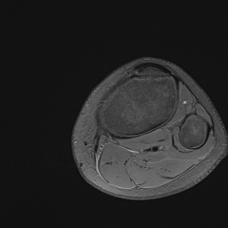 File:Anterior cruciate ligament tear - pediatric (Radiopaedia 62152-70260 Axial PD fat sat 36).jpg