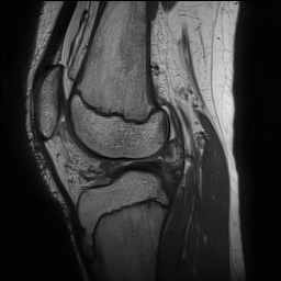 File:Anterior cruciate ligament tear - pediatric (Radiopaedia 62152-70260 Sagittal PD 104).jpg