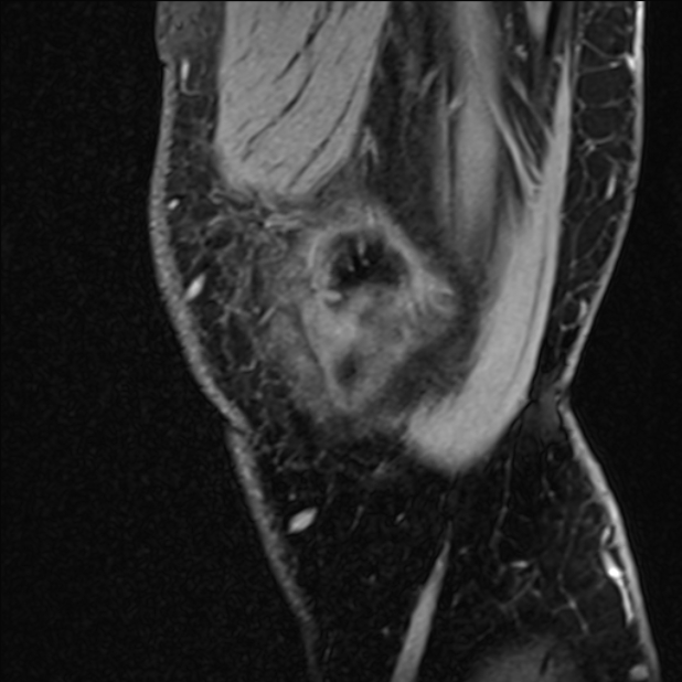 Anterior cruciate ligament tear - ramp lesion (Radiopaedia 71883-82322 Sagittal T1 vibe 128).jpg