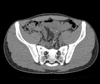 Anterior inferior iliac spine avulsion fracture (Radiopaedia 81312-94999 Axial non-contrast 32).jpg
