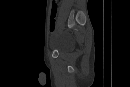 Anterior inferior iliac spine avulsion injury (Radiopaedia 88666-105376 Sagittal bone window 64).jpg