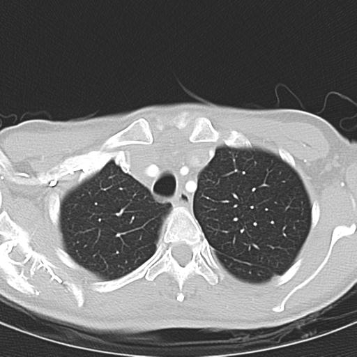 Anterior mediastinal lymphoma (Radiopaedia 29556-30061 Axial lung window 11).jpg