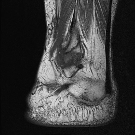 File:Anterior talofibular ligament injury - rupture with soft-tissue impingement (Radiopaedia 38765-40928 Sagittal PD 16).jpg