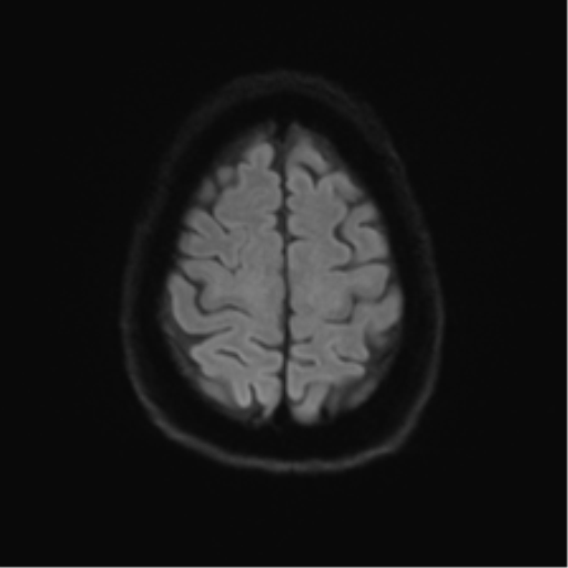 Anterior temporal pole cysts (Radiopaedia 46629-51102 Axial DWI 50).png