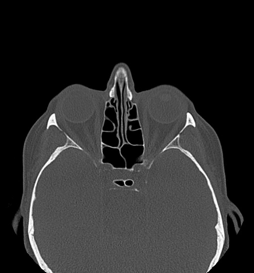 File:Anterior temporomandibular joint dislocation (Radiopaedia 59430-66784 Axial non-contrast 2).jpg