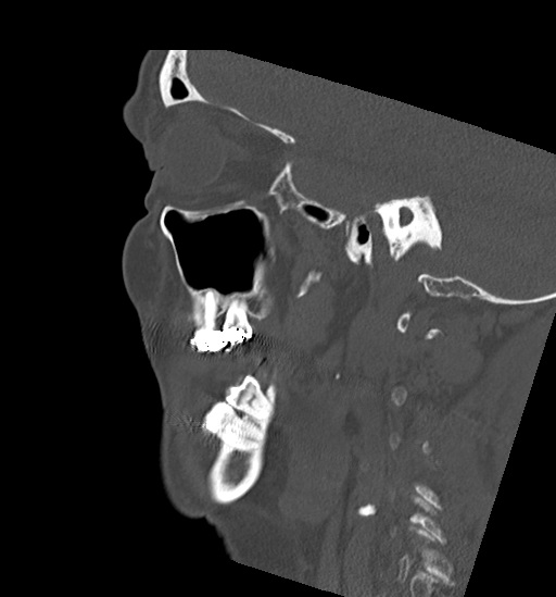 Anterior temporomandibular joint dislocation (Radiopaedia 59430-66784 B 18).jpg