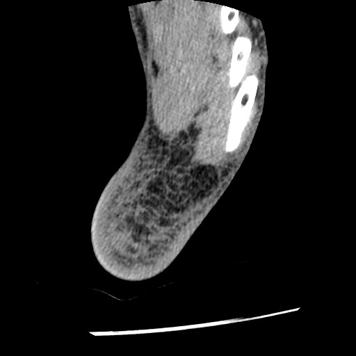 Anterior tibial artery false aneurysm (Radiopaedia 88984-105809 A 245).jpg