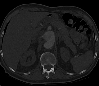 File:Anterior vertebral scalloping (abdominal aortic aneurysm) (Radiopaedia 66744-76067 Axial bone window 40).jpg