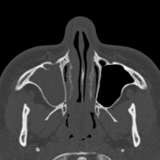 Antrochoanal polyp (Radiopaedia 33984-35202 Axial bone window 19).jpg