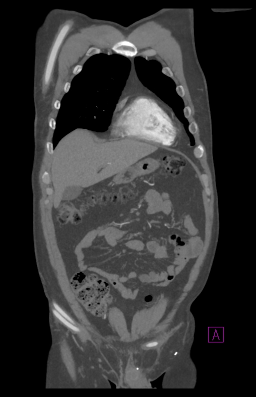 Aortectomy and axillary-bifemoral bypass (Radiopaedia 28303-28545 C 25).jpg