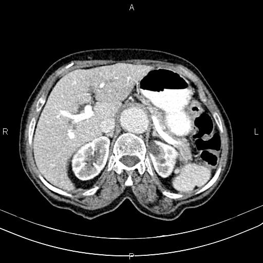 File:Aortic aneurysm and Lemmel syndrome (Radiopaedia 86499-102554 A 24).jpg