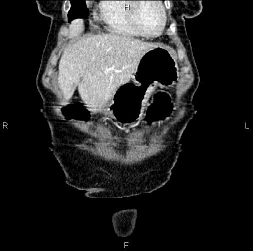 File:Aortic aneurysm and Lemmel syndrome (Radiopaedia 86499-102554 C 7).jpg