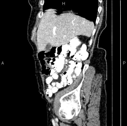 File:Aortic aneurysm and Lemmel syndrome (Radiopaedia 86499-102554 D 17).jpg