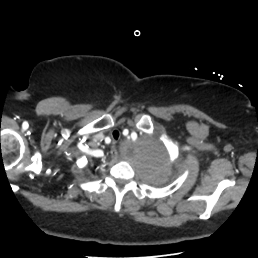 File:Aortic aneurysm and dissection - Stanford type A (Radiopaedia 36693-38261 A 10).png