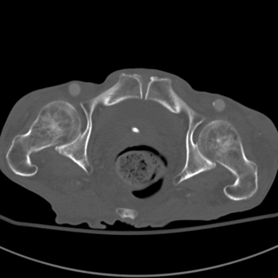Aortic aneurysm with spinal destruction (Radiopaedia 42301-45410 Axial bone window 111).jpg