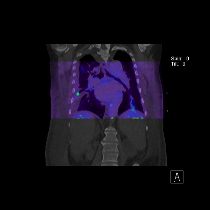 Aortic arch graft infection (FDG PET-CT) (Radiopaedia 71975-82438 D 55).jpg