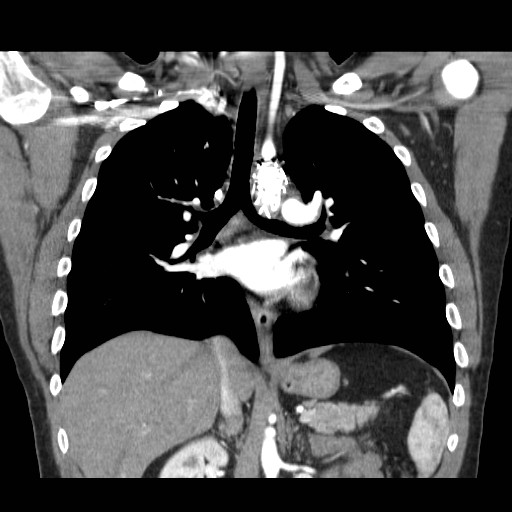File:Aortic arch stent (Radiopaedia 30030-30595 F 16).jpg