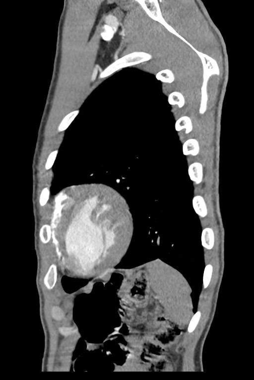 Aortic coarctation with aneurysm (Radiopaedia 74818-85828 B 135).jpg