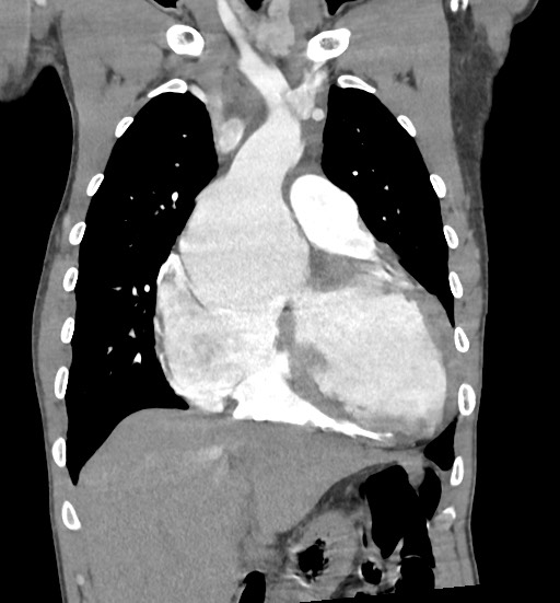 Aortic coarctation with aneurysm (Radiopaedia 74818-85828 C 39).jpg