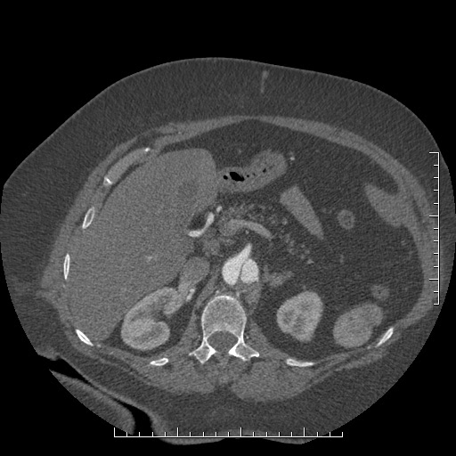 Aortic dissection- Stanford A (Radiopaedia 35729-37268 B 51).jpg
