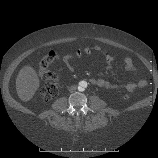File:Aortic dissection- Stanford A (Radiopaedia 35729-37268 C 25).jpg