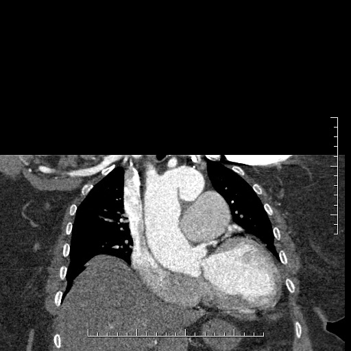 File:Aortic dissection- Stanford A (Radiopaedia 35729-37268 E 41).jpg
