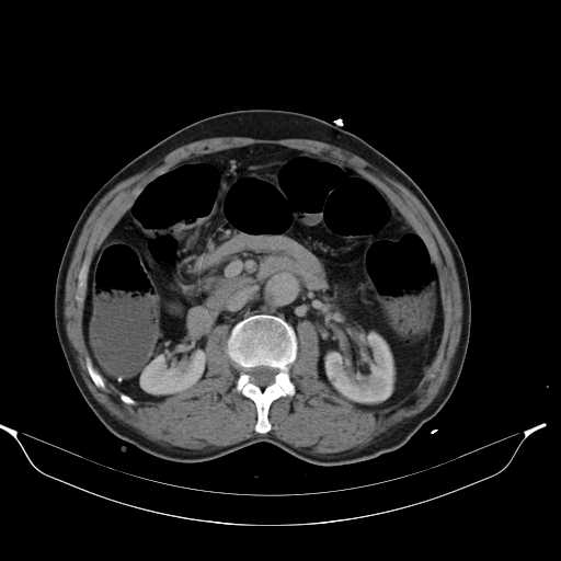 File:Aortic dissection- Stanford type A (Radiopaedia 22085-22085 Axial C+ delayed 22).jpg