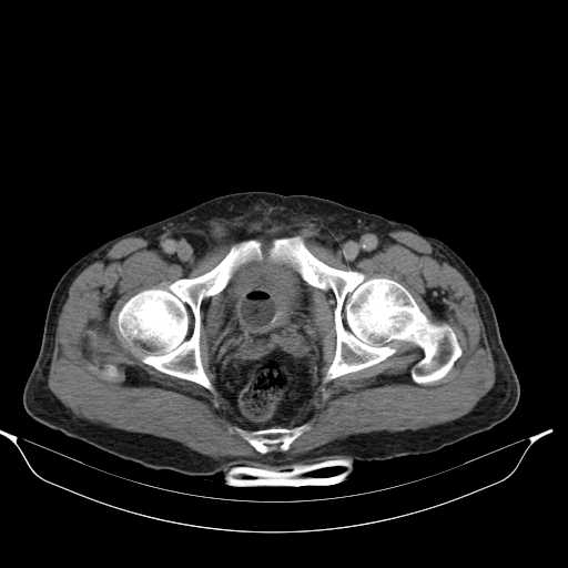 File:Aortic dissection- Stanford type A (Radiopaedia 22085-22085 Axial C+ delayed 51).jpg