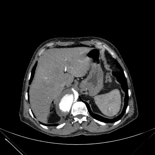Aortic dissection (Radiopaedia 27466-27665 C+ arterial phase 261).jpg
