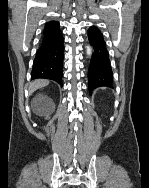 Aortic dissection (Radiopaedia 44411-48061 A 59).jpg