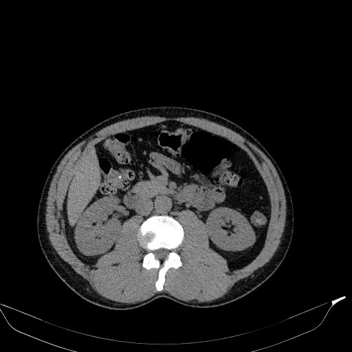 Aortic dissection - Stanford type A (Radiopaedia 83418-98500 Axial non-contrast 55).jpg
