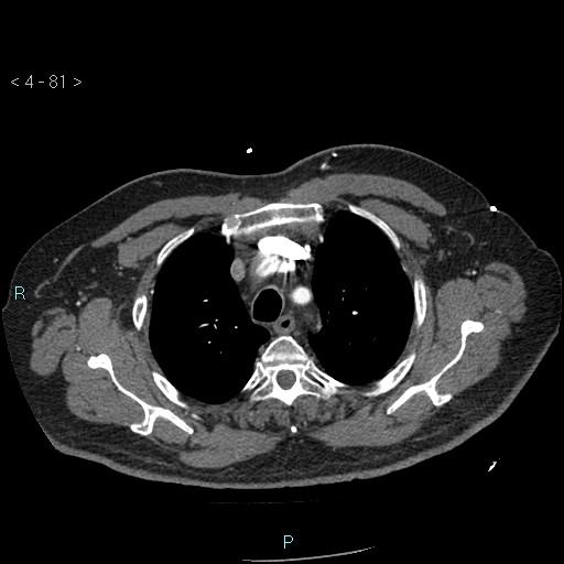 File:Aortic intramural hematoma (Radiopaedia 48463-53380 B 37).jpg