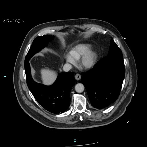 Aortic intramural hematoma (Radiopaedia 48463-53380 C 119).jpg