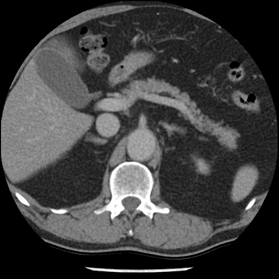 Aortic intramural hematoma (type B) (Radiopaedia 79323-92387 Axial C+ delayed 60).jpg