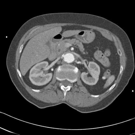 Aortic intramural hematoma from penetrating atherosclerotic ulcer (Radiopaedia 31137-31836 A 93).jpg