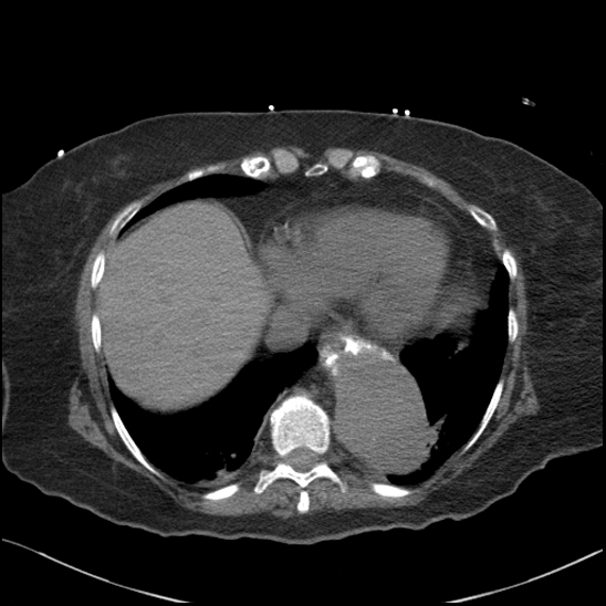 Aortic intramural hematoma with dissection and intramural blood pool (Radiopaedia 77373-89491 Axial non-contrast 75).jpg
