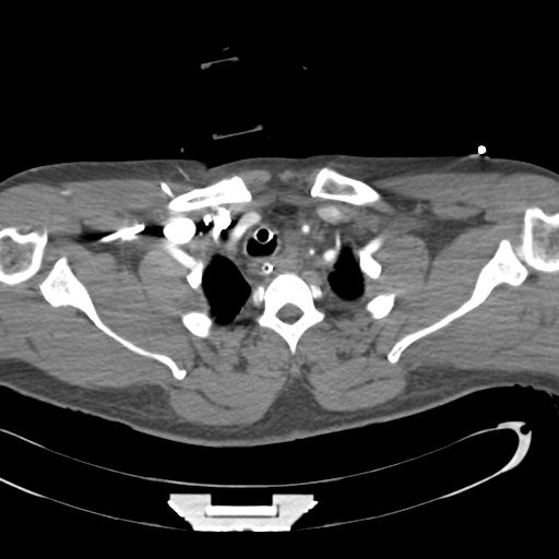 Aortic transection, diaphragmatic rupture and hemoperitoneum in a complex multitrauma patient (Radiopaedia 31701-32622 A 13).jpg